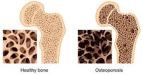 luu osteoporoos